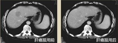 放化疗不再痛苦,活着有奔头... 放化疗不再痛苦,活着有奔头...