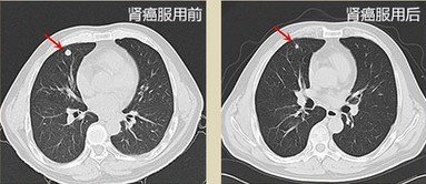 灵芝孢粉,把我的肾癌控制住了! 灵芝孢粉,把我的肾癌控制住了!