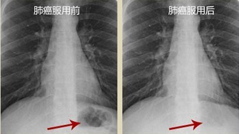 灵芝孢粉,让我的肺癌消失了! 灵芝孢粉,让我的肺癌消失了!